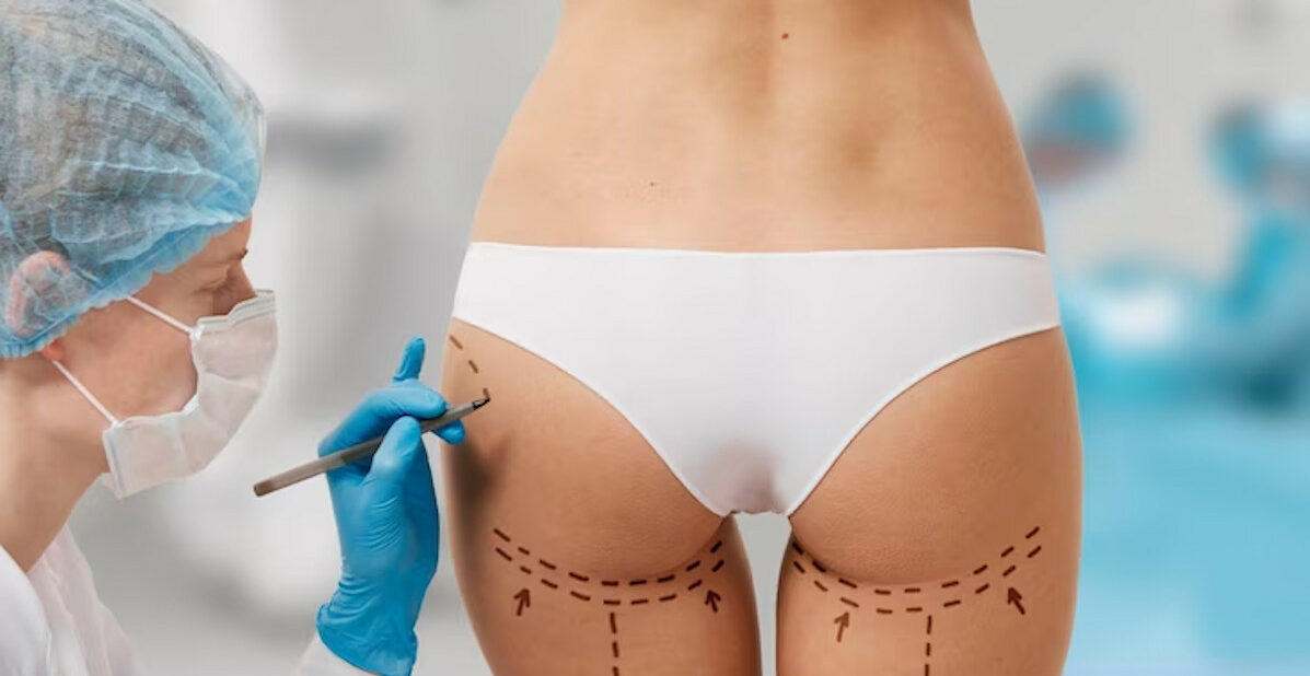 chirurgie fesse