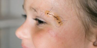 Closeup smiling patient kid girl face with stitches, joint on scratch of eyebrow dissection look