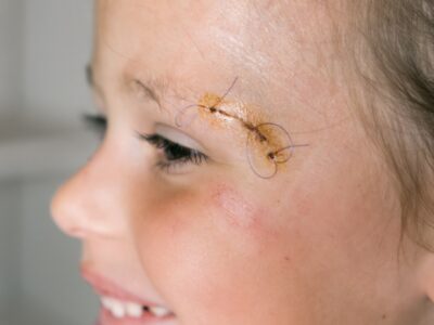 Closeup smiling patient kid girl face with stitches, joint on scratch of eyebrow dissection look