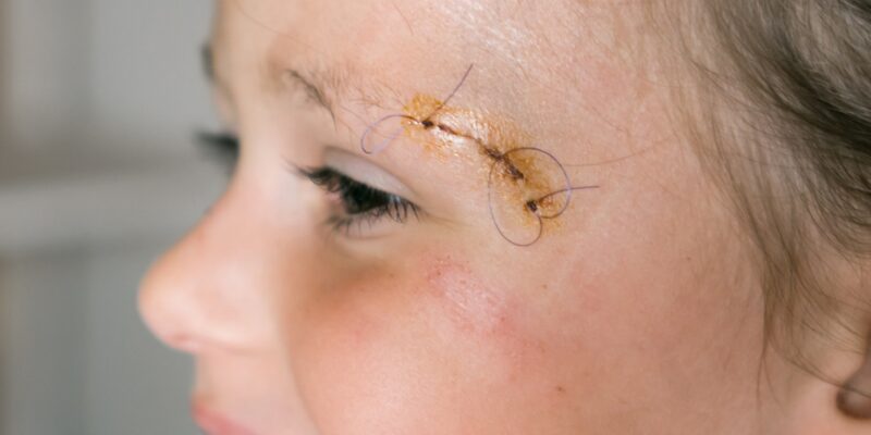 Closeup smiling patient kid girl face with stitches, joint on scratch of eyebrow dissection look