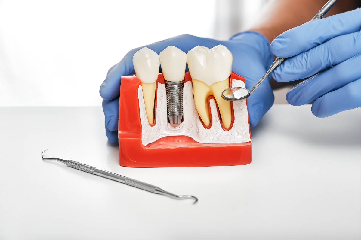 implants dentaires